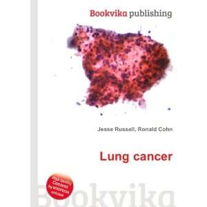 Lung cancer [Paperback]