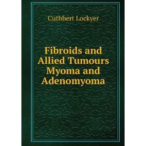  Fibroids and Allied Tumours Myoma and Adenomyoma Cuthbert 